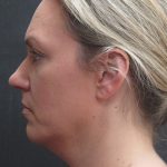 Scarless Facelift and Necklift Before & After Patient #3101