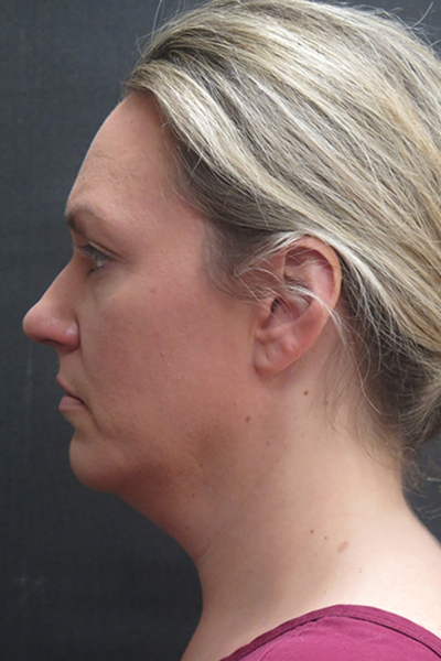 Scarless Facelift and Necklift Before & After Patient #3101