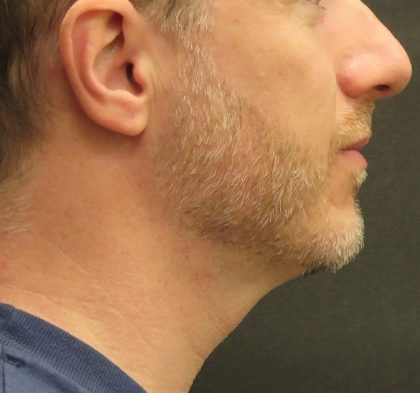 Scarless Facelift and Necklift Before & After Patient #3074