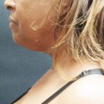 Scarless Facelift and Necklift Before & After Patient #1910