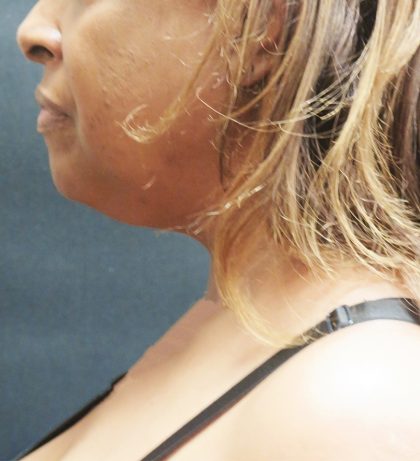 Scarless Facelift and Necklift Before & After Patient #1910