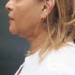 Scarless Facelift and Necklift Before & After Patient #3081