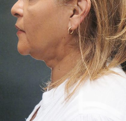 Scarless Facelift and Necklift Before & After Patient #3081