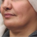 Scarless Facelift and Necklift Before & After Patient #3094