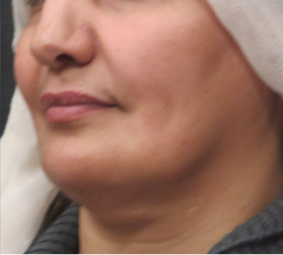 Scarless Facelift and Necklift Before & After Patient #3094