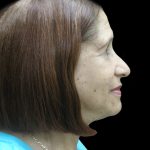 Fat Transfer Before & After Patient #1765