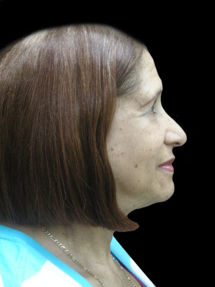 Fat Transfer Before & After Patient #1765