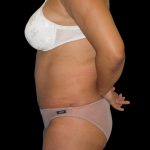 Tummy Tuck Before & After Patient #3146