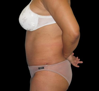Tummy Tuck Before & After Patient #3146