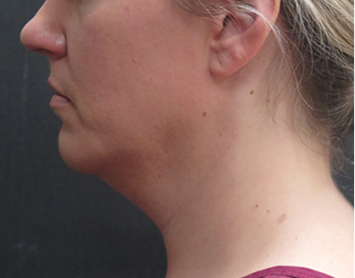 Fat Transfer Before & After Patient #1789