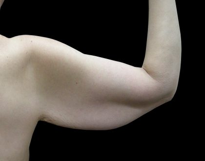 Arm Lift Before & After Patient #897