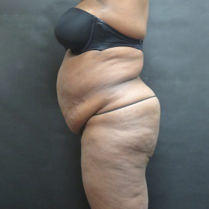 Mommy Makeover Before & After Patient #2503
