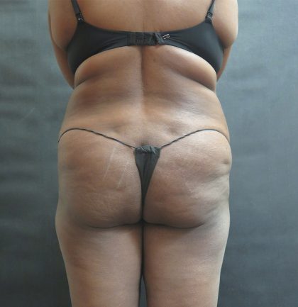 Mommy Makeover Before & After Patient #2529
