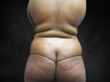 Mommy Makeover Before & After Patient #2587