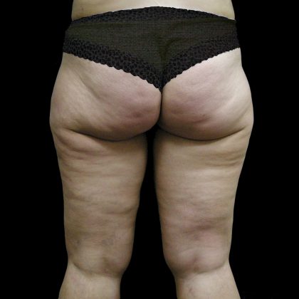 Mommy Makeover Before & After Patient #2490