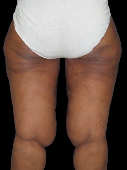 Thigh Lift Before & After Patient #3137