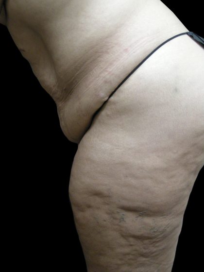 Post Weight Loss Before & After Patient #2791