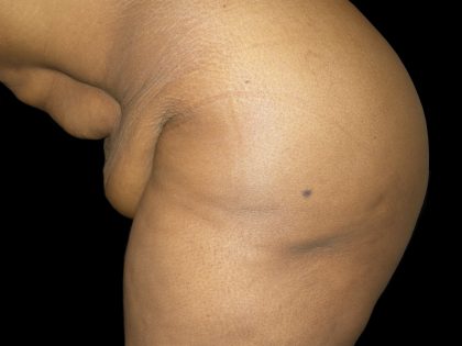 Lower Body Lift Before & After Patient #2327