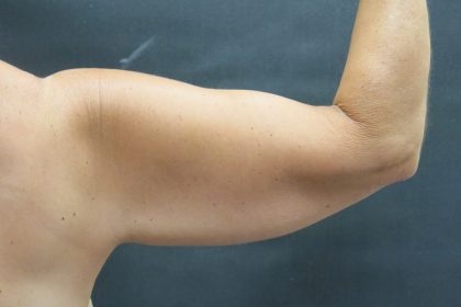 Arm Lift Before & After Patient #888