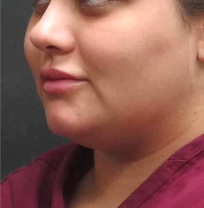 Scarless Facelift and Necklift Before & After Patient #3028