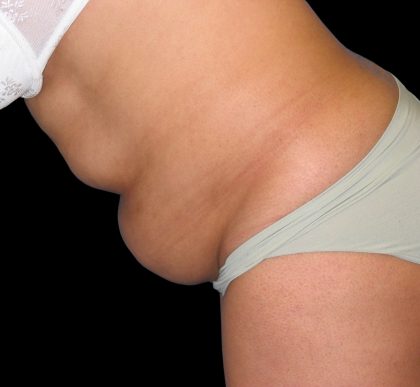 Tummy Tuck Before & After Patient #3146
