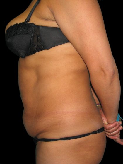Tummy Tuck Before & After Patient #3155