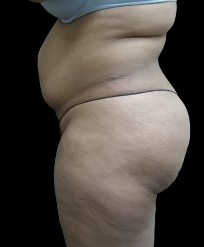 Tummy Tuck Before & After Patient #3166