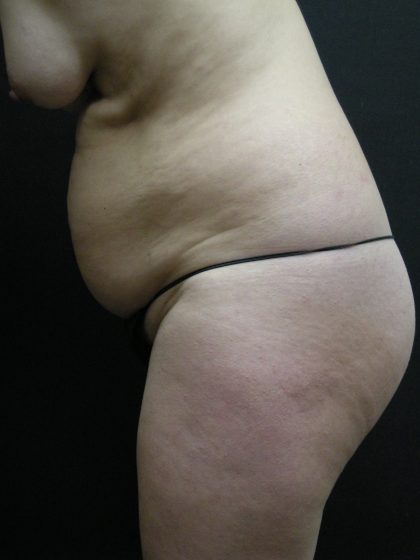 Mommy Makeover Before & After Patient #2657