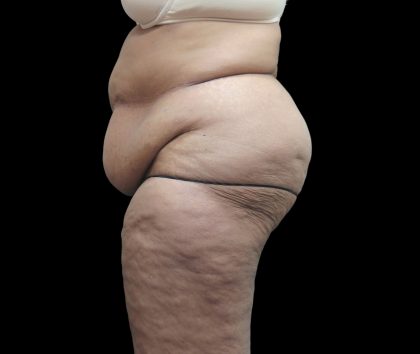 Tummy Tuck Before & After Patient #3209