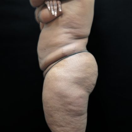 Tummy Tuck Before & After Patient #3267