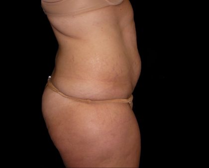 Tummy Tuck Before & After Patient #3321
