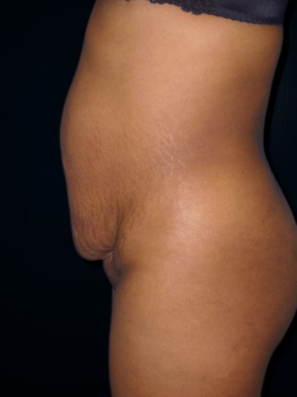 Tummy Tuck Before & After Patient #3366