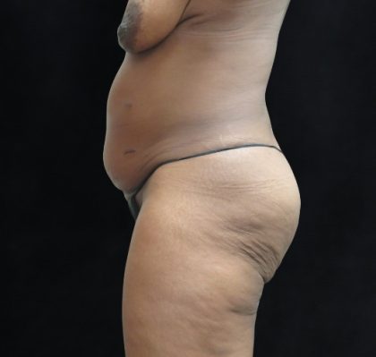 Tummy Tuck Before & After Patient #3387