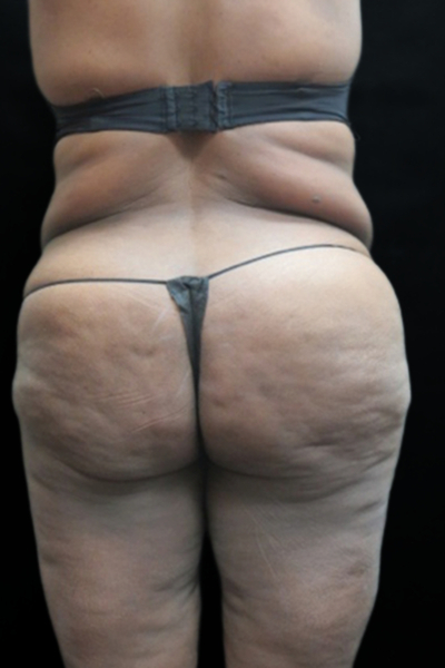 Tummy Tuck Before & After Patient #3412