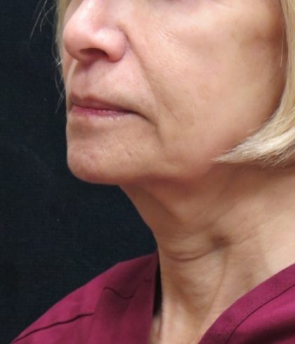 Levinelift Before & After Patient #2008