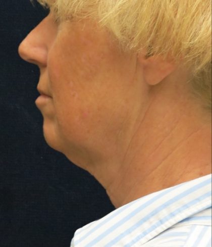 Levinelift Before & After Patient #1999