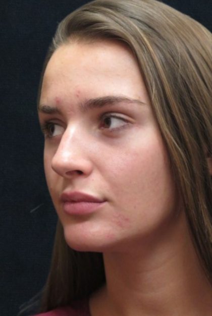 Rhinoplasty Before & After Patient #2926