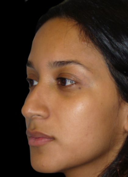 Rhinoplasty Before & After Patient #2905
