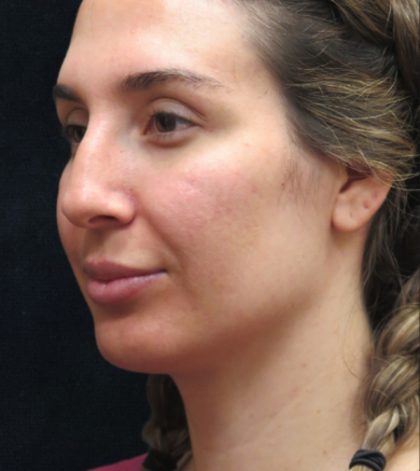 Rhinoplasty Before & After Patient #2851