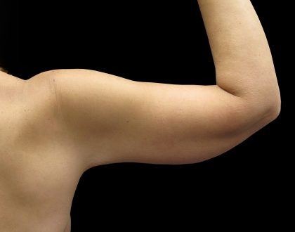 Arm Lift Before & After Patient #897