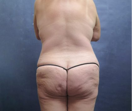 Mommy Makeover Before & After Patient #2542