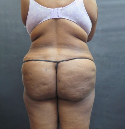 Mommy Makeover Before & After Patient #2529