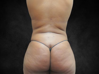 Mommy Makeover Before & After Patient #2587