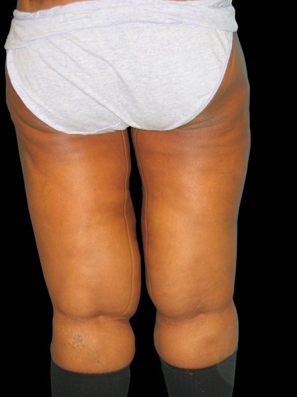 Thigh Lift Before & After Patient #3137