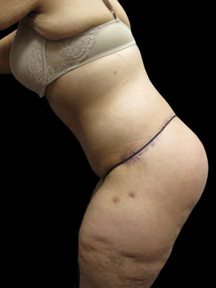 Post Weight Loss Before & After Patient #2791