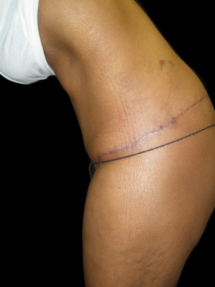 Lower Body Lift Before & After Patient #2327