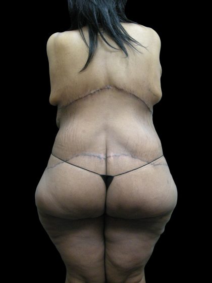 Lower Body Lift Before & After Patient #2294
