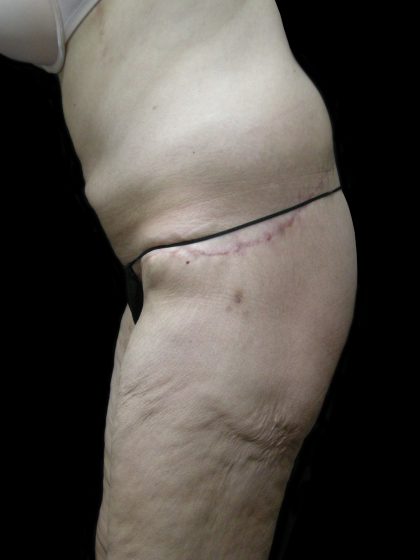 Lower Body Lift Before & After Patient #2305