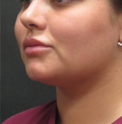 Scarless Facelift and Necklift Before & After Patient #3028