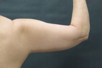 Arm Lift Before & After Patient #888